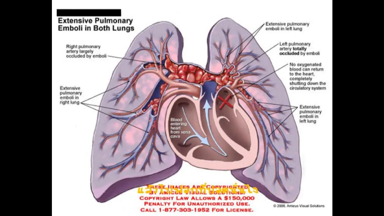 Легочные артерии анатомия. Легочная артерия человека. Ле¬Гоч¬ная ар¬те¬рия. Легочная артерия и ее ветви. Сколько легочных артерий