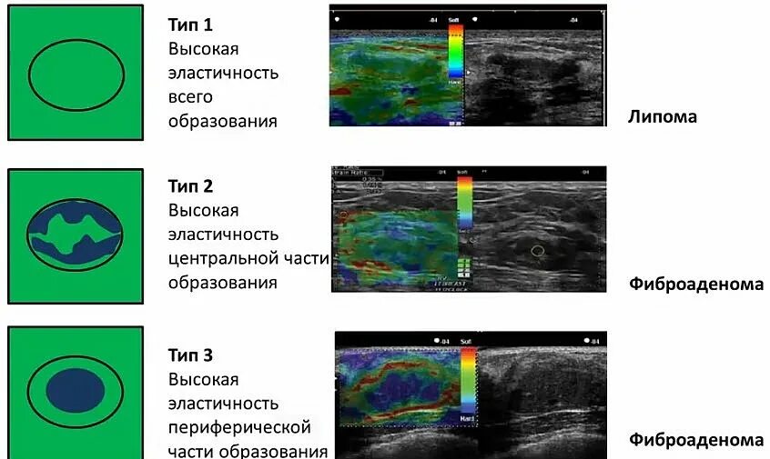 Эластография молочных желез УЗИ протокол. Эластография щитовидной железы протокол УЗИ. Эластография молочной железы протокол УЗИ. Эластография молочных желез протокол.