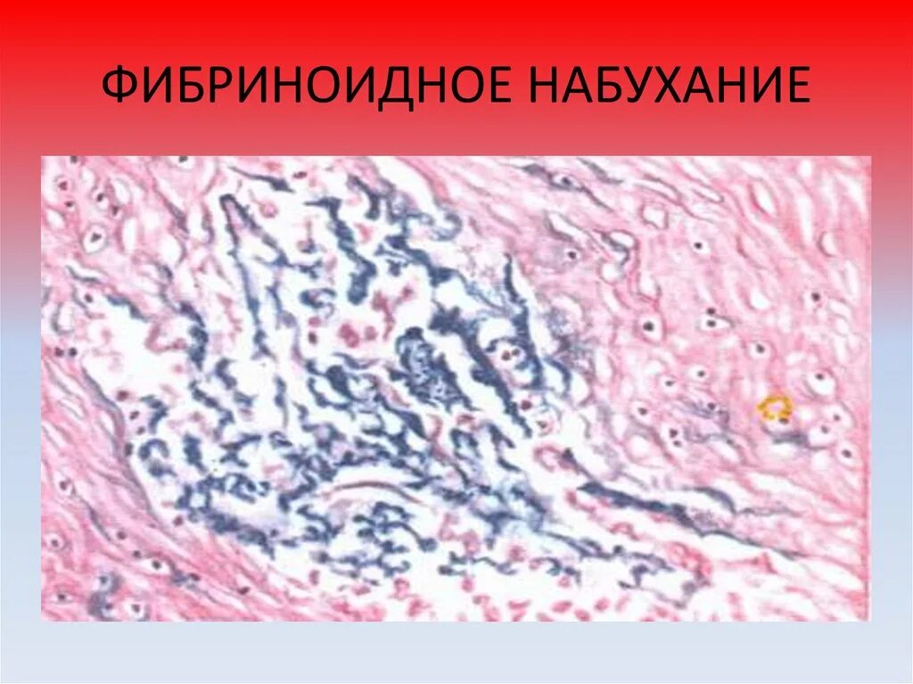 Фибриноидное набухание соединительной ткани препарат. Фибриноидное набухание соединительной ткани микропрепарат. Фибриноидное набухание гистология. Мукоидное набухание фибриноидное набухание гиалиноз.