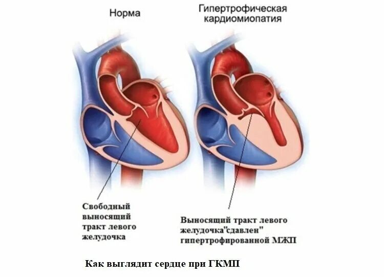 Заболевания левого желудочка. Кардиопатия гипертрофия. ЭХОКГ гипертрофия кардиомиопатия. Дилатационная кардиомиопатия УЗИ сердца. Концентрическая кардиомиопатия.