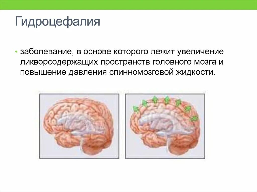 Причины гидроцефалии мозга. Гидроцефалия нервной системы у детей. Наружная заместительная гидроцефалия. Заболевание гидроцефалия. Гидроцефалия презентация.