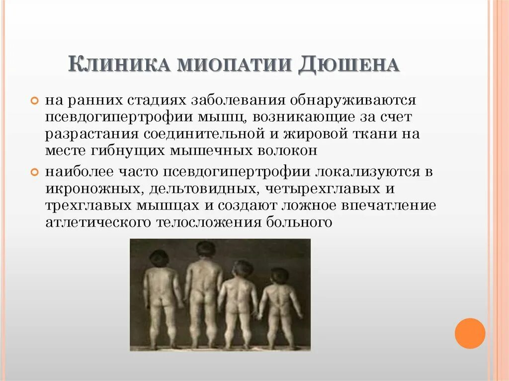 Миопатия что это за болезнь. Миодистрофия Дюшенна симптомы у детей. Дистрофия Дюшенна Тип наследования. Миопатия Дюшенна клинические проявления. Мышечная листрофия Дюшина.