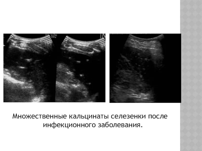 Кальцинат в правой доле. Кальциноз селезенки на УЗИ. Микрокальцинаты в печени на УЗИ. Микрокальцинаты селезенки на УЗИ. Микрокальциноз селезенки.