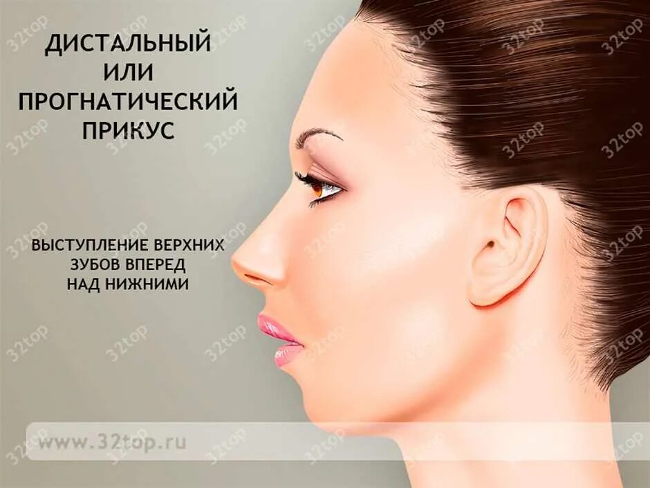 Глубокий дистальный прикус. Оратор и аудитория. Выступает вперед. Поясничный лордоз. Лицо человека европеоидной расы.