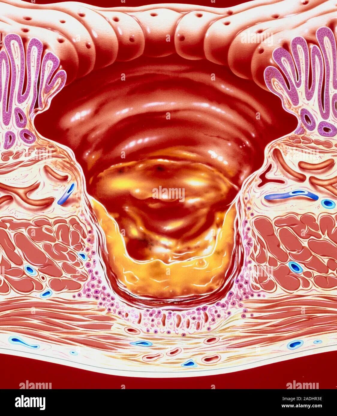 Язва 12 перстной кишки эндоскопия. Атлас эндоскопии язва желудка. Эрозия слизистой оболочки кишечника. Гигантская язва желудка. Слизистая оболочка 12 кишки