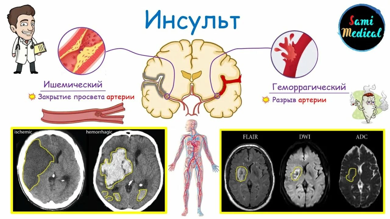 Мозговой инсульт патогенез. Ишемический инсульт головного мозга клиника. Этиология инсульта. Лакунарный ишемический инсульт.