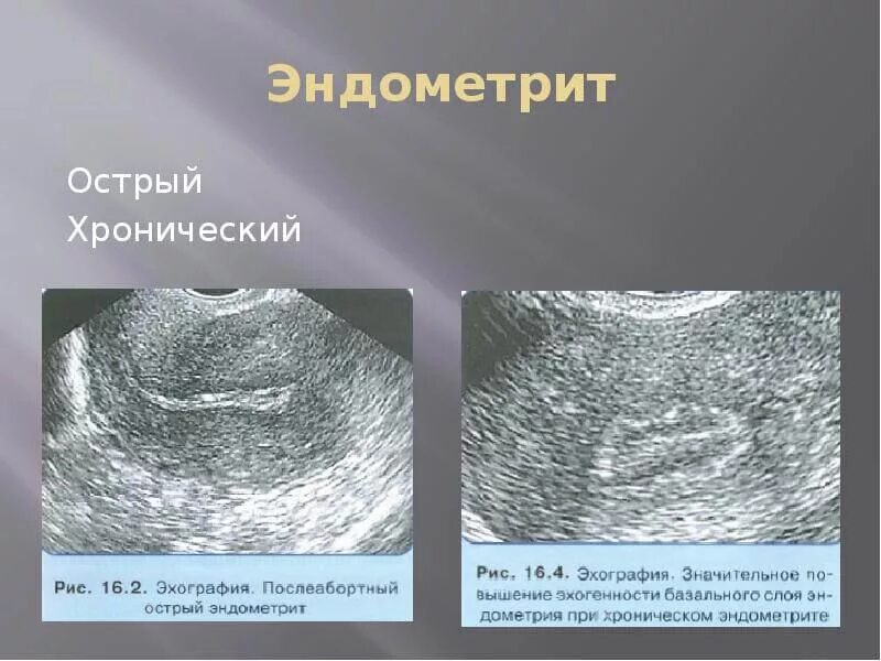 Изменения эндоцервикса. Послеродовый эндометрит УЗИ. Хронический эндометрит УЗИ. Хронический эндометрит УЗИ картина.