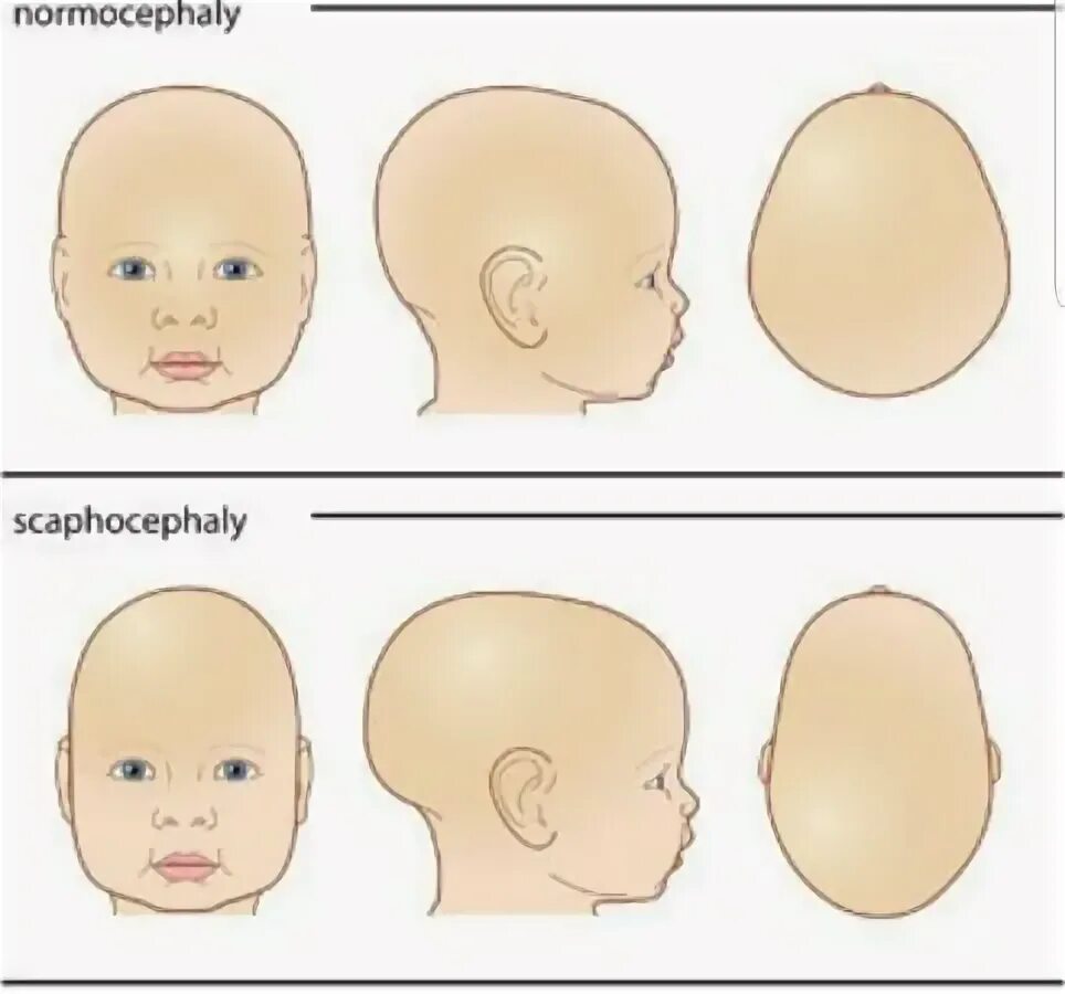Мозг новорожденного норма. Кривошея плагиоцефалия. Деформация черепа плагиоцефалия.. Краниосиностоз плагиоцефалия. Компенсаторная лобная плагиоцефалия.
