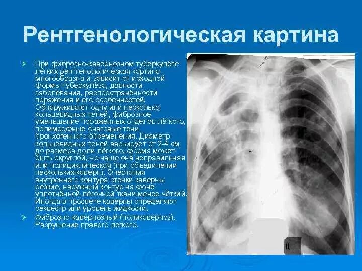 Рентгенологическая картина. Фиброзно-кавернозный туберкулез рентген. Фиброзно-кавернозный туберкулез легких рентген. Кавернозная форма туберкулеза легких рентген. Кавернозный туберкулез рентген.