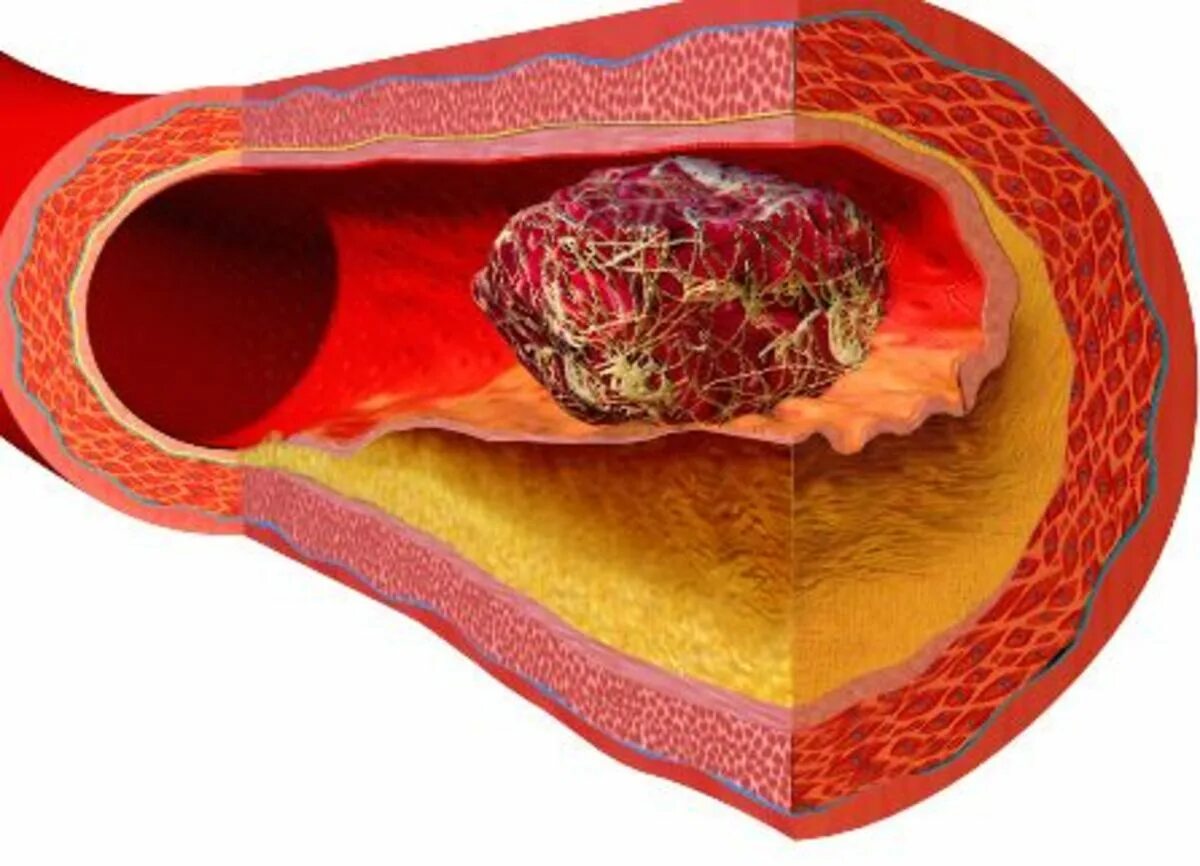 Возникновение тромбов