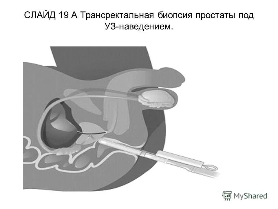 Транзиторная зона предстательной железы