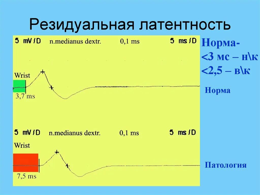 Изменение м н о. Резидуальная латентность. Периферическая латентность норма. Резидуальная латентность показатели ЭНМГ. Резидуальная латентность и ПДК норма.