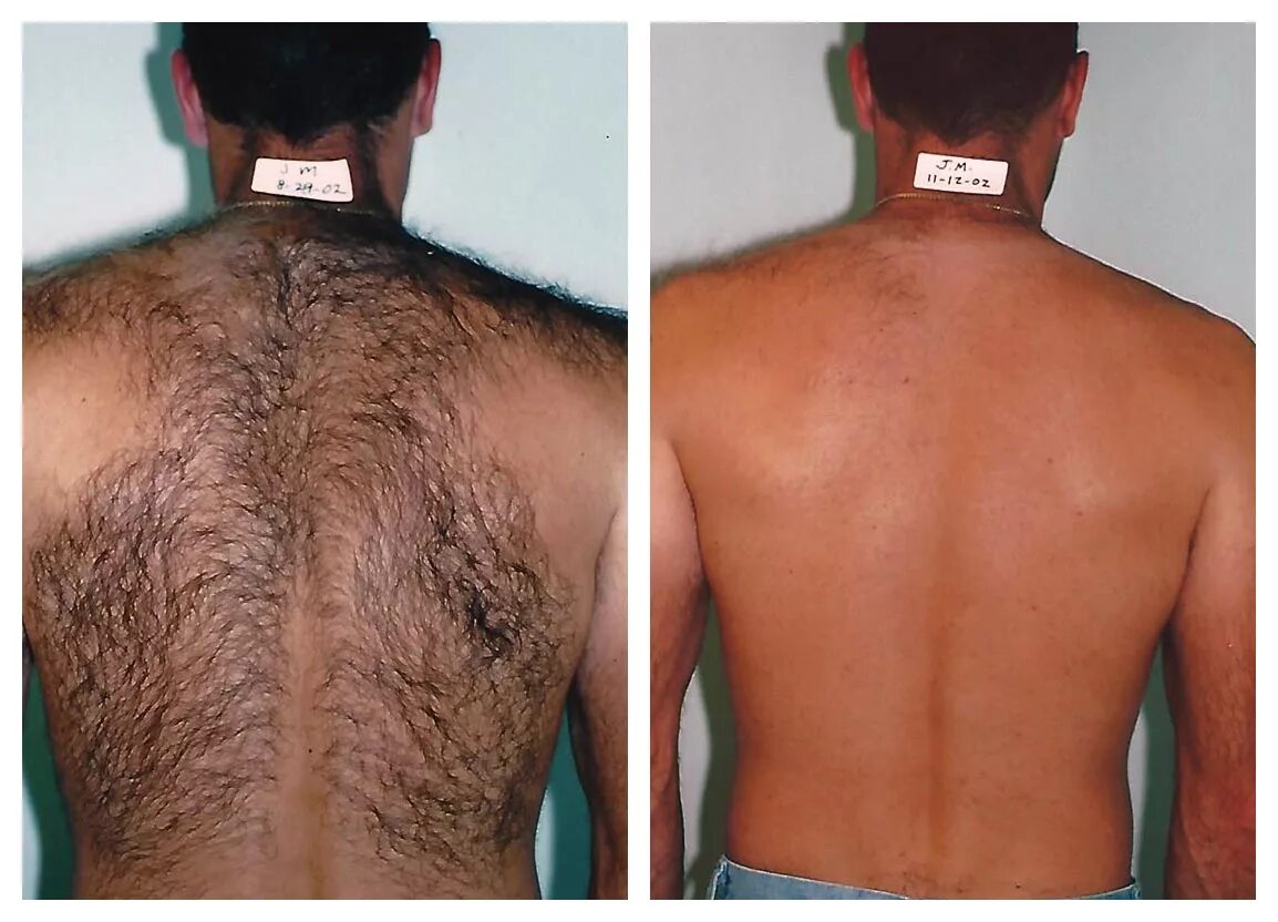 Эпиляция спины до и после. Мужская лазерная эпиляция спины. Лазерная эпиляция спины.