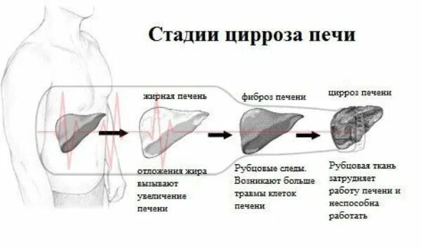 Печень последняя стадия сколько живут. Цирроз печени стадии развития. Этапы разрушения печени. Степени разрушения печени. Цирроз начальный степень.