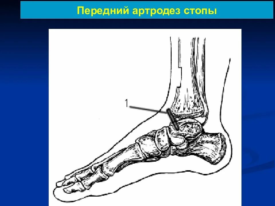 Подтаранный артродез стопы. Артропластика голеностопного сустава. Артродез голеностопного сустава. Артродез суставов операция