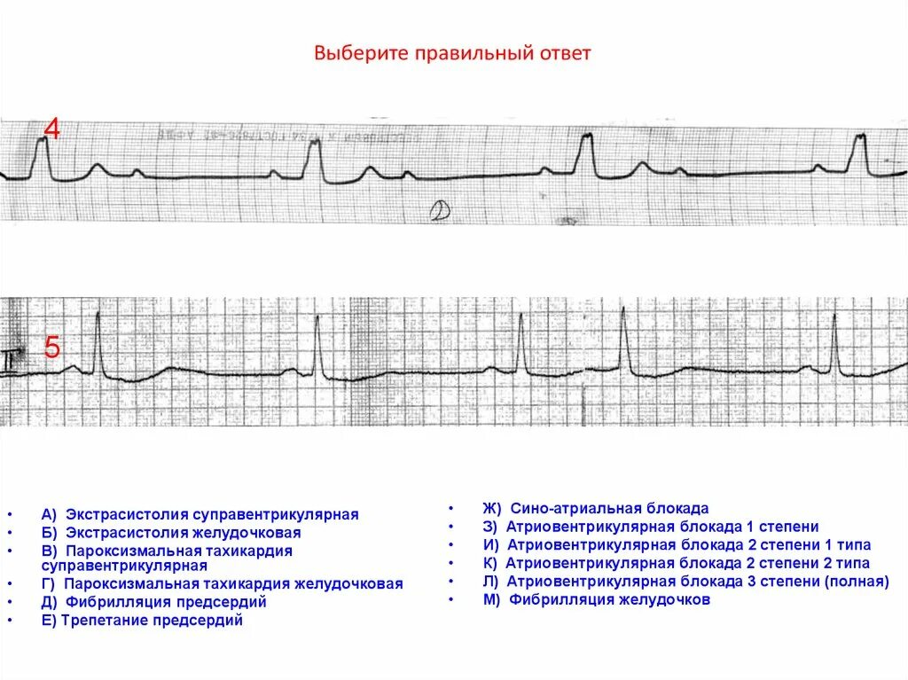 Атриовентрикулярная экстрасистолия на ЭКГ. После желудочковой экстрасистолы атриовентрикулярная блокада. ЭКГ экстрасистолы блокады. Av блокады и экстрасистолы на ЭКГ. Блокада экстрасистолы
