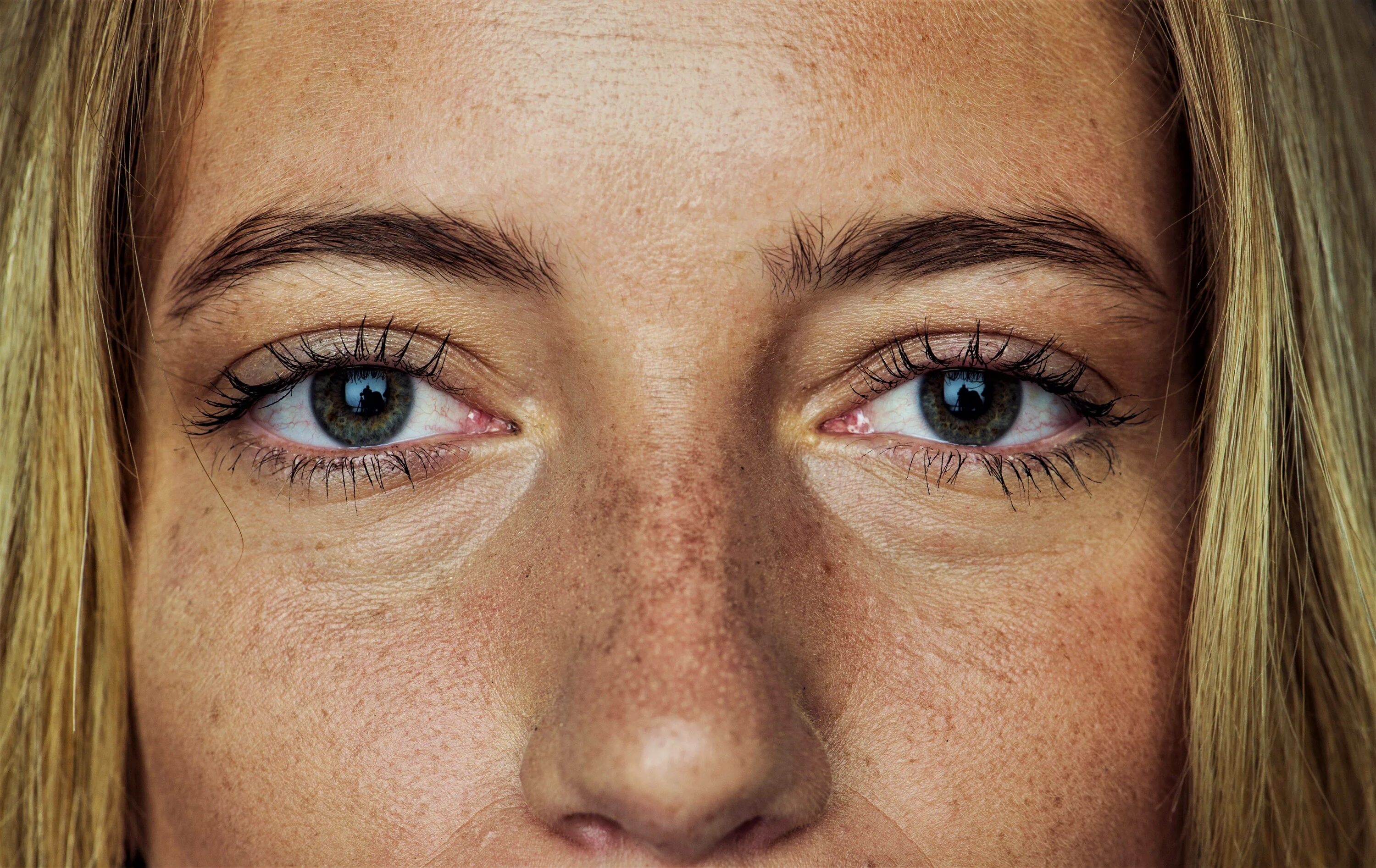 Желтые круги вокруг глаз у женщин причины. Мешки под глазами. Пигментация вокруг глаз. Круги под глазами. Огромные круги под глазами.