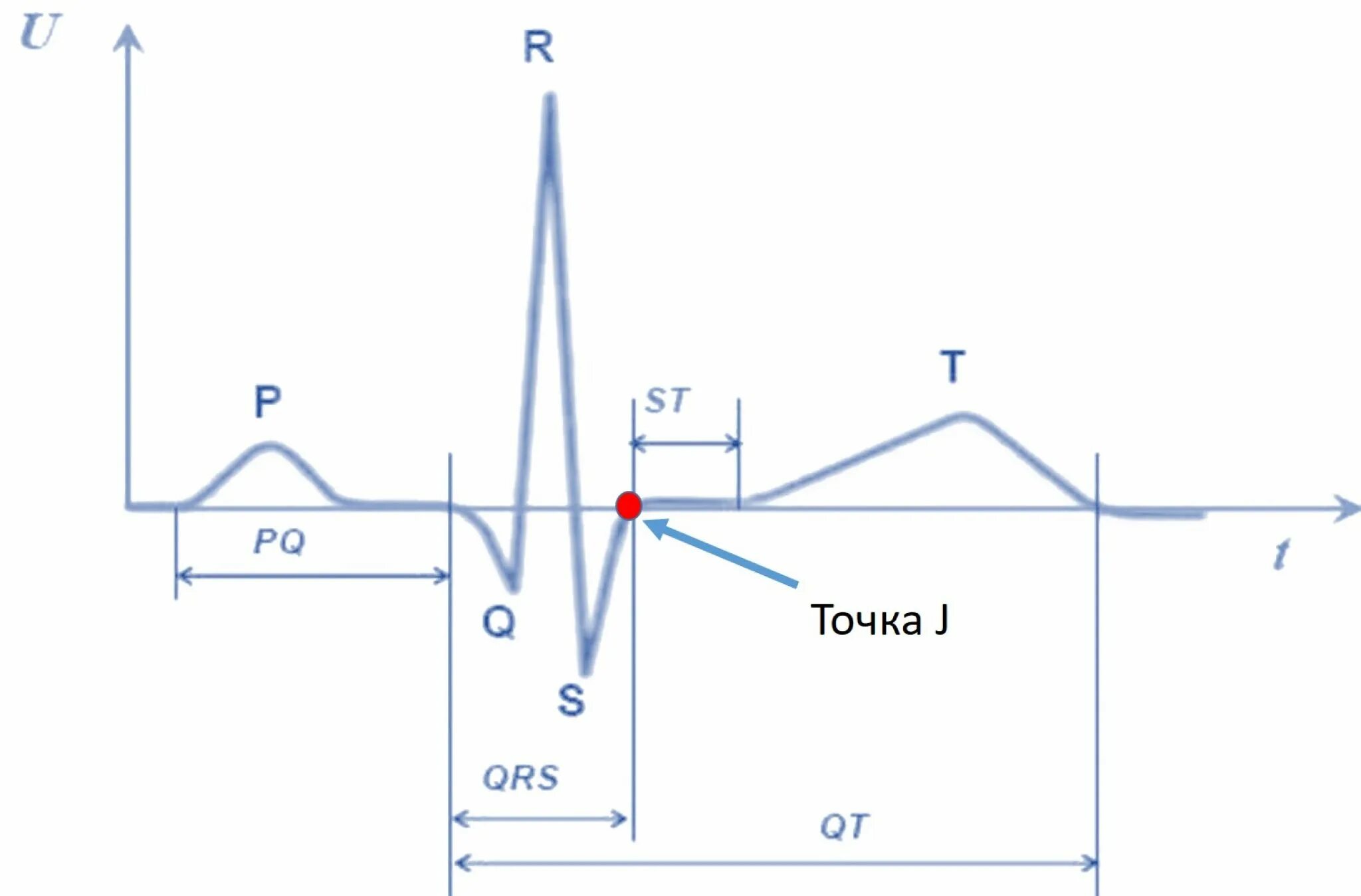 Найти точку дж. Элевация сегмента St на ЭКГ. Точки j сегмента St. Точка j на ЭКГ. Элевация точки j— элевация сегмента St.