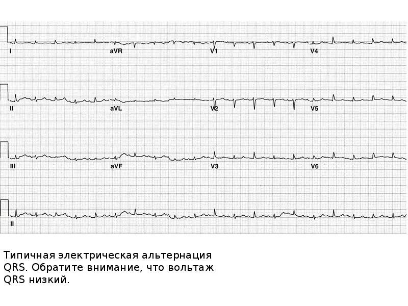 Альтернация комплекса QRS на ЭКГ. Электрическая альтернация на ЭКГ. ЭКГ электрическая альтернация комплексов. Комплекс QRS на ЭКГ. Мв на экг