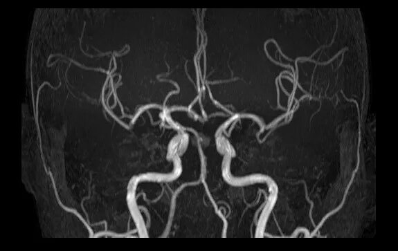 Гипоплазия позвоночной артерии мрт. Гипоплазия позвоночной артерии кт. Гипоплазия позвоночной артерии диаметр. Ангиография позвоночной артерии. Гипоплазия правой артерии головного мозга