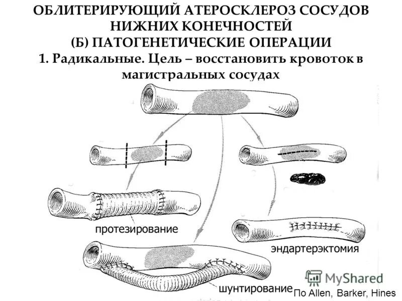 Облитерирующий атеросклероз операция. Облитерирующий атеросклероз артерий нижних конечностей. Операции при атеросклерозе сосудов нижних конечностей. Облитерирующий атеросклероз сосудов ног. Операция шунтирование нижних