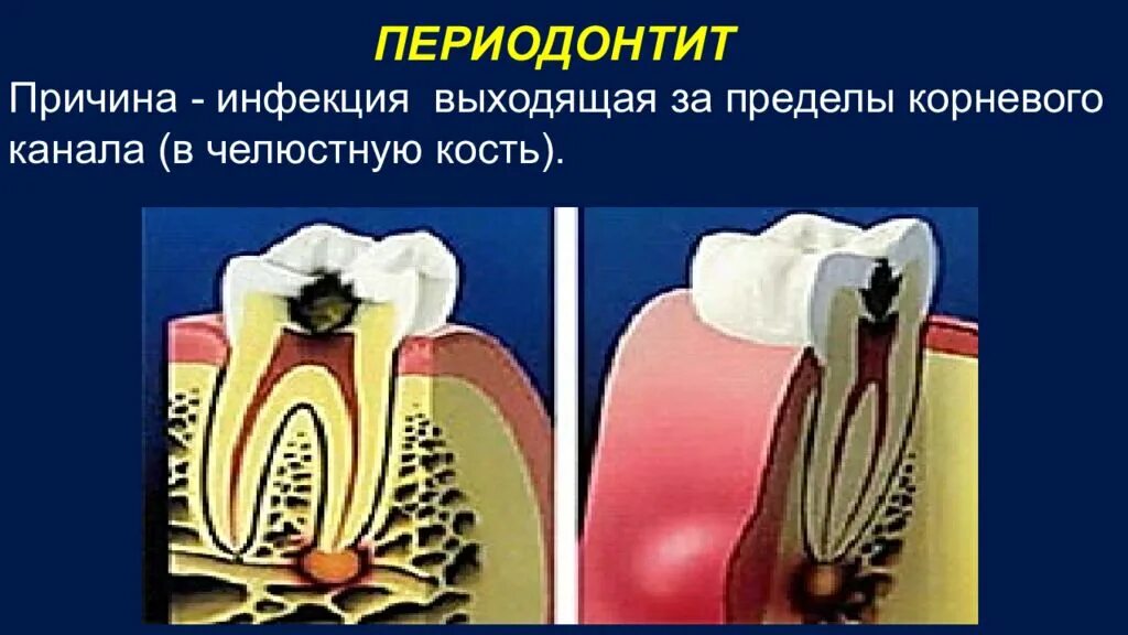 Рокс периодонт. Трехкорневой периодонтит. строение зуба периодонтит.