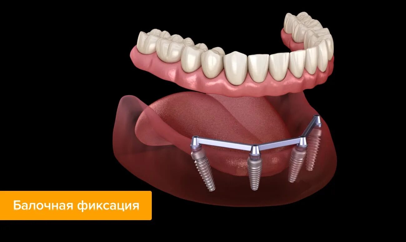 Балочная система фиксации на имплантах. Балочная система на 4 имплантах. Съемный протез с балочной системой фиксации. Бюгельный протез балочная система. Как крепятся съемные