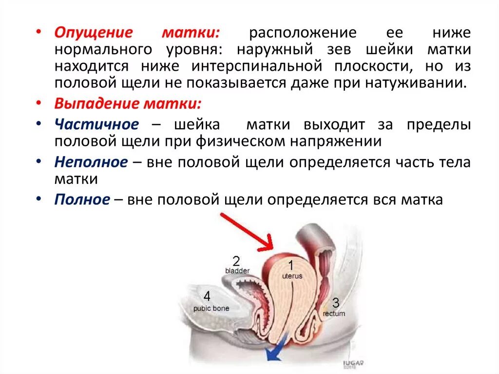 Чем грозит опущение. Выпадение шейки матки степени. Пролапс выпадение матки. Опущение и пролапс матки. Выпадение и опущение шейки матки.