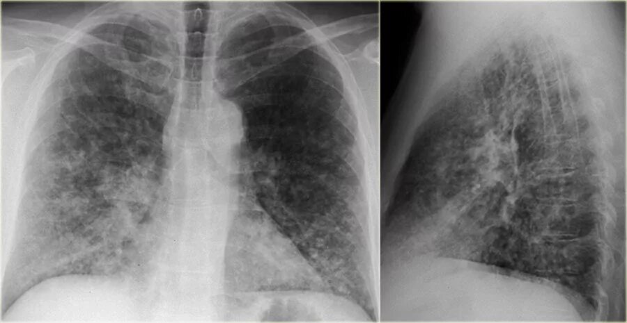 Поражения правого легкого. Интерстициальная пневмония рентген. Интерстициальная пневмония у детей рентген. Интерстициальная пневмония рентген легких.