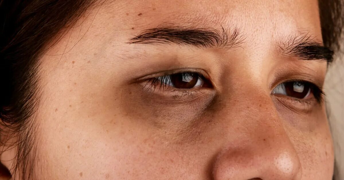 Темные круги под глазами женщин лечение. Периорбитальная гиперпигментация. Круги под глазами. Пигментация вокруг нлаза. Коричневая пигментация вокруг глаз.