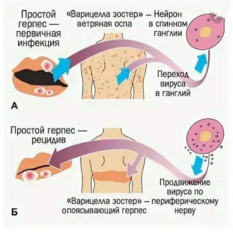 Герпес вируса человека 1 типа у детей. Вирус герпеса клинические проявления. Вирус простого герпеса 1 и 2 типа проявление. Вирус простого герпеса 1 и 2 типа что это у детей симптомы. Herpes virus 6