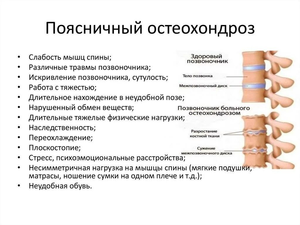 Симптомы поясничного остеохондроза