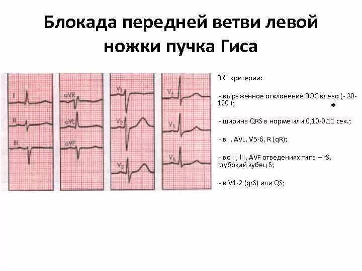 Блокада пучка гиса на экг у ребенка. ЭКГ критерии блокады левой ножки пучка Гиса. Полная блокада ЛНПГ на ЭКГ. Неполная блокада ЛНПГ на ЭКГ. Блокада левой ножки пучка Гиса на ЭКГ.