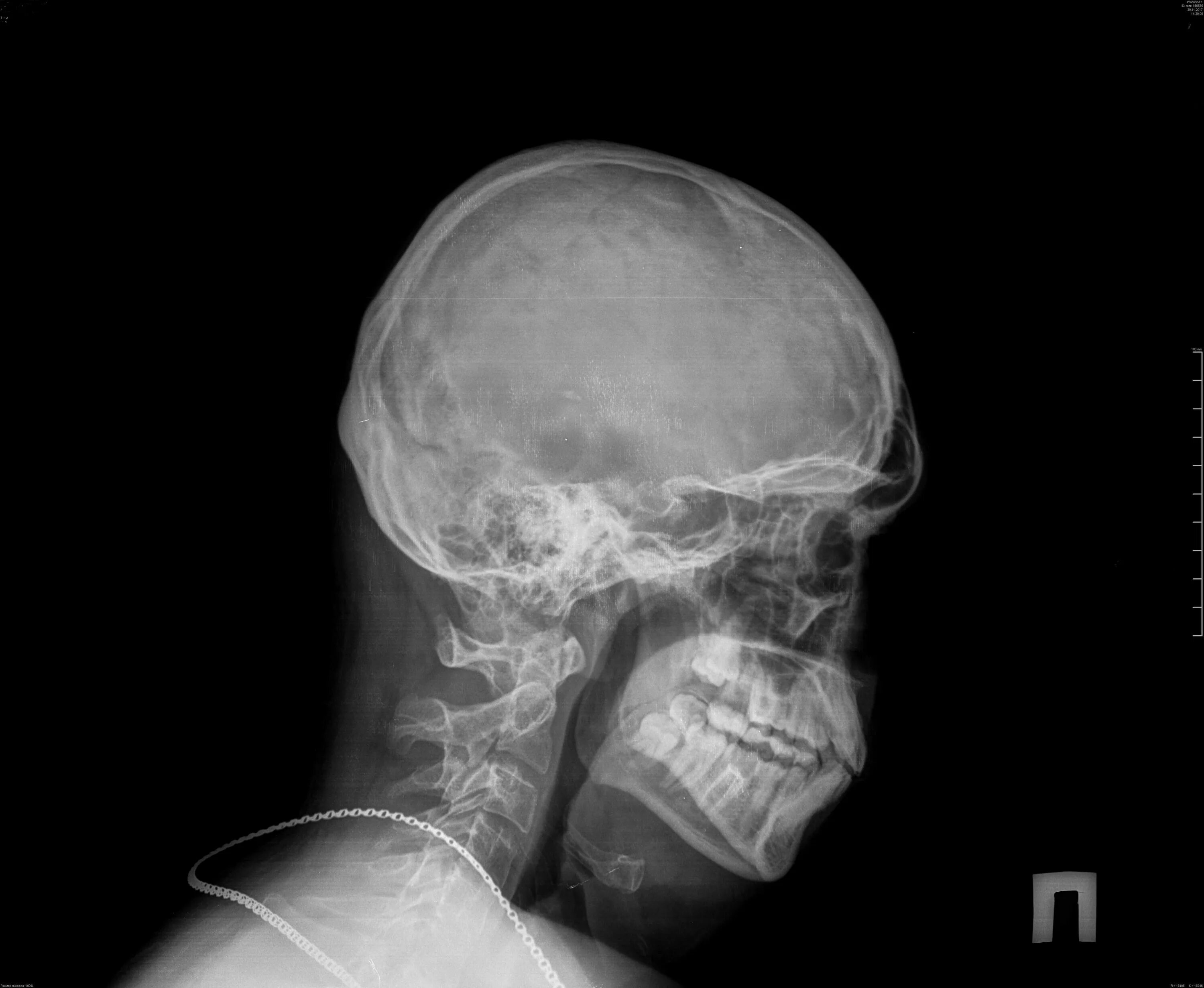 Трещина в голове. Кости черепа рентген норма. Рентгенограмма черепа в боковой проекции норма. Рентген снимок черепа норма. Рентген черепа сбоку здорового.