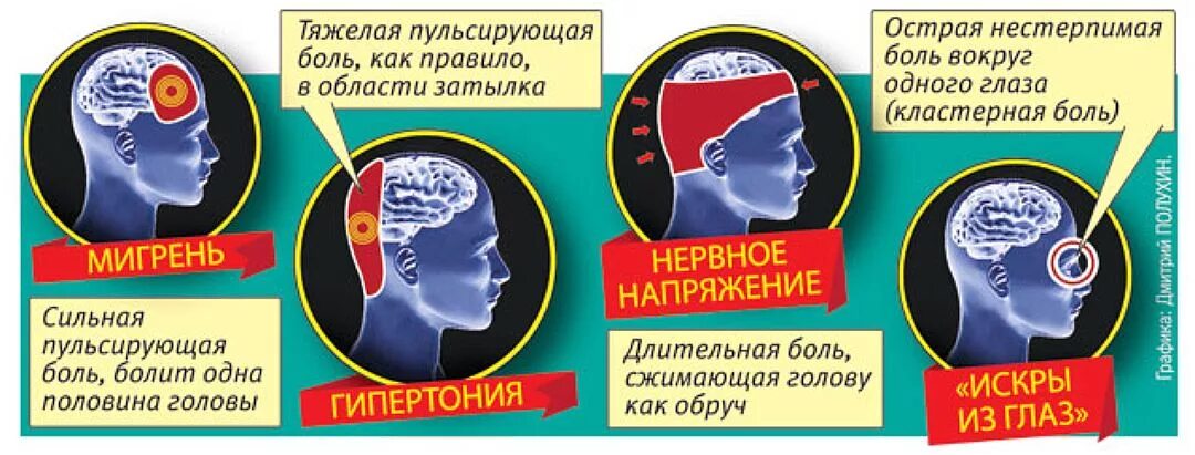 Как убрать сильную боль. Типы головной боли. Затылочная головная боль. Головная боль локализация. Головная боль в задней части.