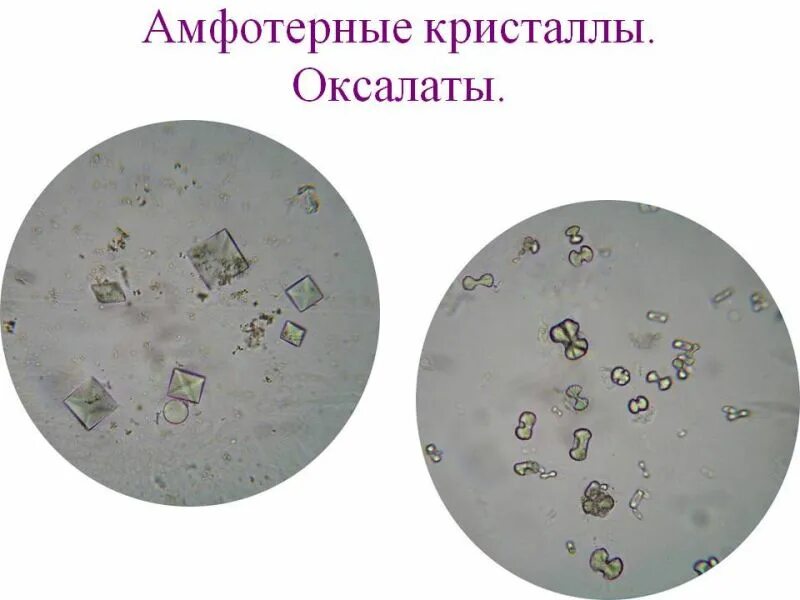 Микроскопия неорганизованного осадка мочи. Микроскопия осадка мочи трипельфосфаты. Микроскопия осадка мочи оксалаты. Кристаллы мочевой кислоты микроскопия.