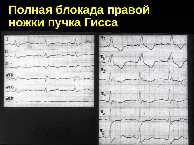 Что означает блокада правой ножки. Блокада правой ножки пучка. Полная блокада правой ножки пучка. Полная блокада правой. Полная блокада правого пучка Галса.