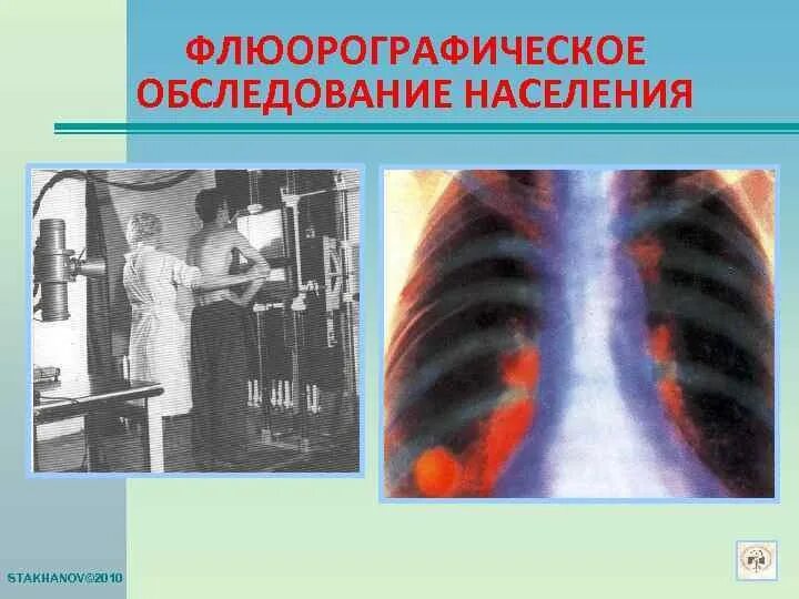 Выявление больных туберкулезом. Методика флюорографии. Флюорографические обследования населения. Флюорографические осмотры населения. Цель флюорографического обследования.