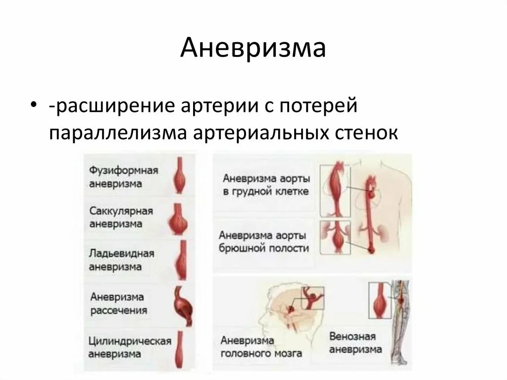 Аневризмы артерий головного мозга классификация. Классификация аневризм сосудов головного мозга. Аневризма периферических артерий. Саккулярная аневризма.