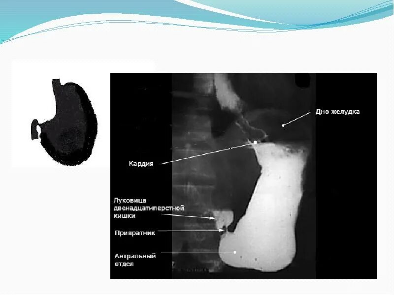 Язва привратника желудка рентген. Стеноз пилорического отдела желудка. Стеноз привратника желудка рентген. Рентгенограмма язва желудка в пилорическом отделе. Прельстил привратник