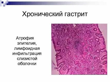 Лимфоидная инфильтрация