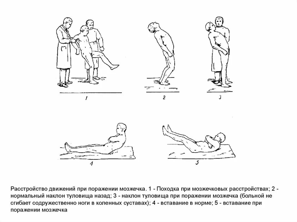 Нарушение функции мозжечка. Упражнения для мозжечка. Походка при поражении мозжечка. Синдромы поражения мозжечка. Реабилитация при поражении мозжечка.
