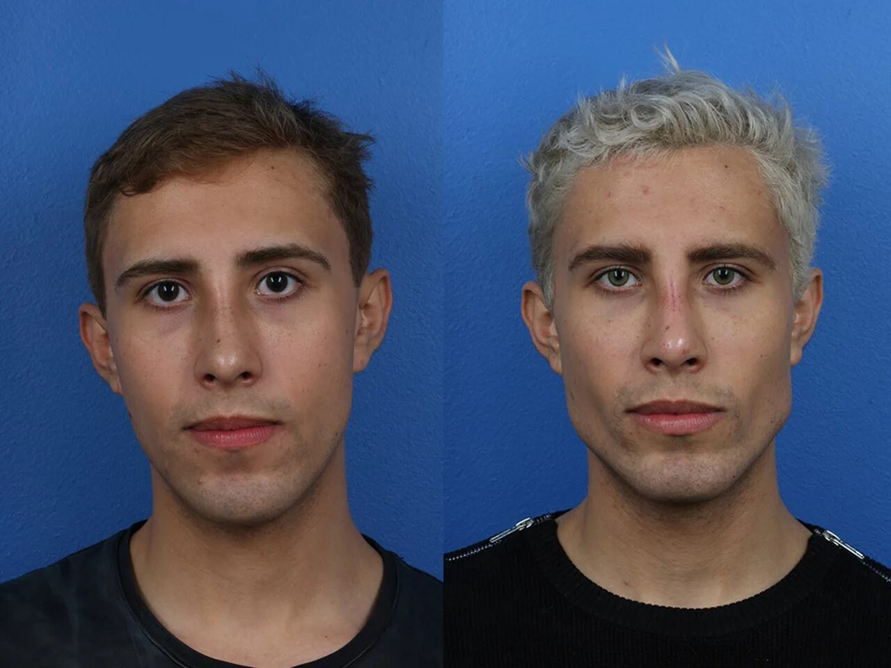 Мужчины после операции. Пластика лица до и после мужчины. Мужская пластика лица фото до и после. Омоложение мужчин до и после.
