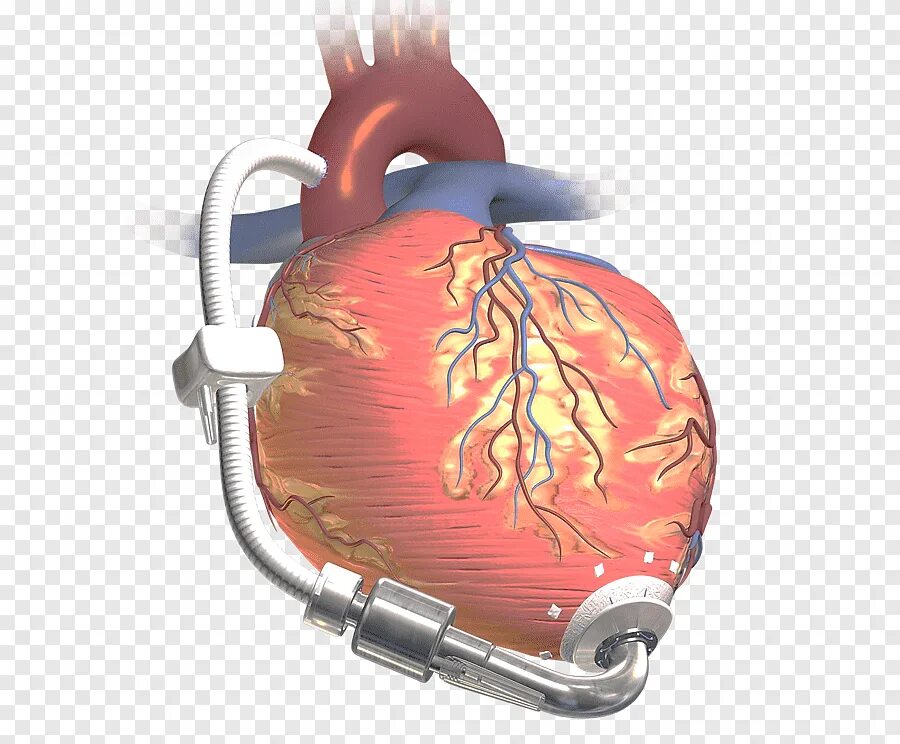 Искусственное сердце аппарат. Искусственный левый желудочек. Искусственный желудочек сердца.