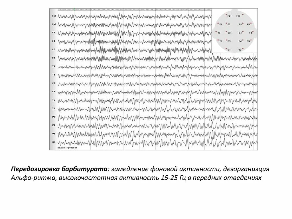 Фоновая ээг. Дезорганизация Альфа ритма на ЭЭГ что это. Гипервентиляционная гиперсинхрония на ЭЭГ. Высокочастотная активность на ЭЭГ. Артефакты ЭЭГ.