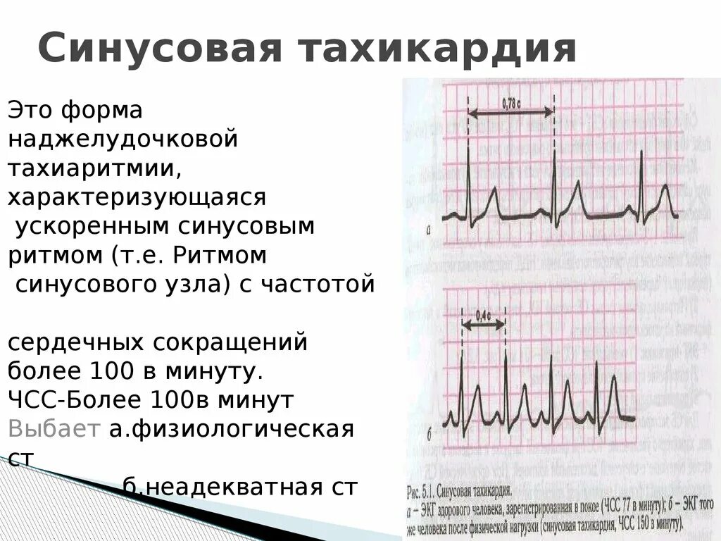 Синусовая аритмия тахикардия. Синусовая тахикардия ЧСС 100 ЭКГ. Ритм синусовый.тахикардия по ЭКГ. Синусовая тахикардия ЭКГ признаки.