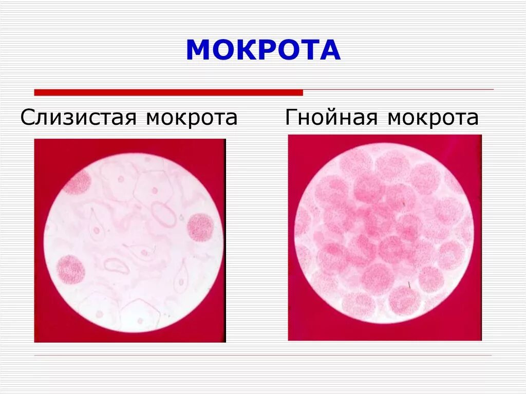 Цвет слизисто-гнойной мокроты.