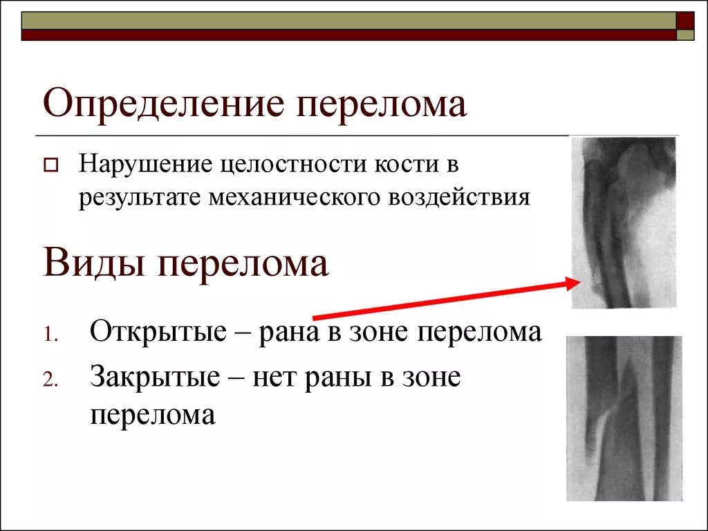 Перелом определение виды. Признаки открытого перелома. Симптомы перелома или трещины