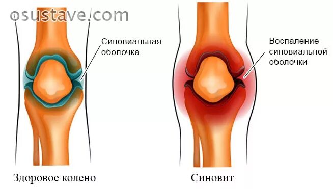 Что такое синовит коленного коленного сустава. Синовит синовиальная оболочка. Синовит это воспаление синовиальной. ,Синовит синовита коленного сустава.