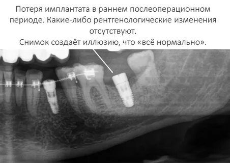 Как приживаются импланты отзывы